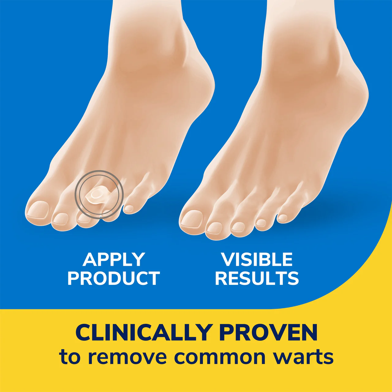 Dr. Scholl's - Clear Away Wart Remover Salicylic Acid Treatment for Common Warts |  9 Strips 12 Medicated Discs - Image 4